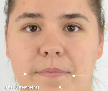 The Newest Acne-Fighter to Know About: Spot Solution